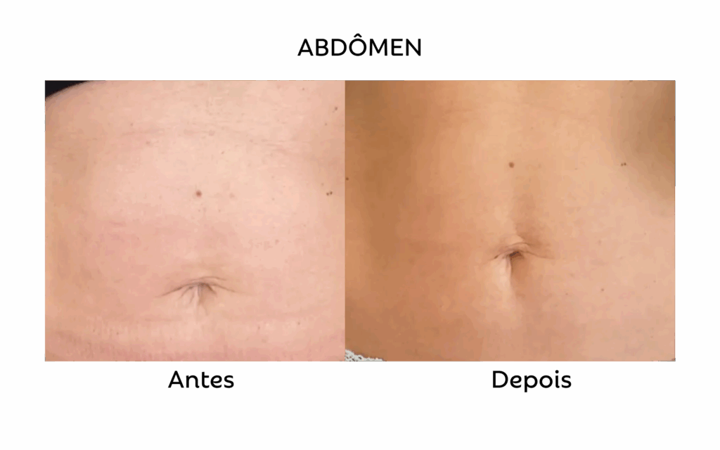 Comparativo de antes e depois identificado como abdômen