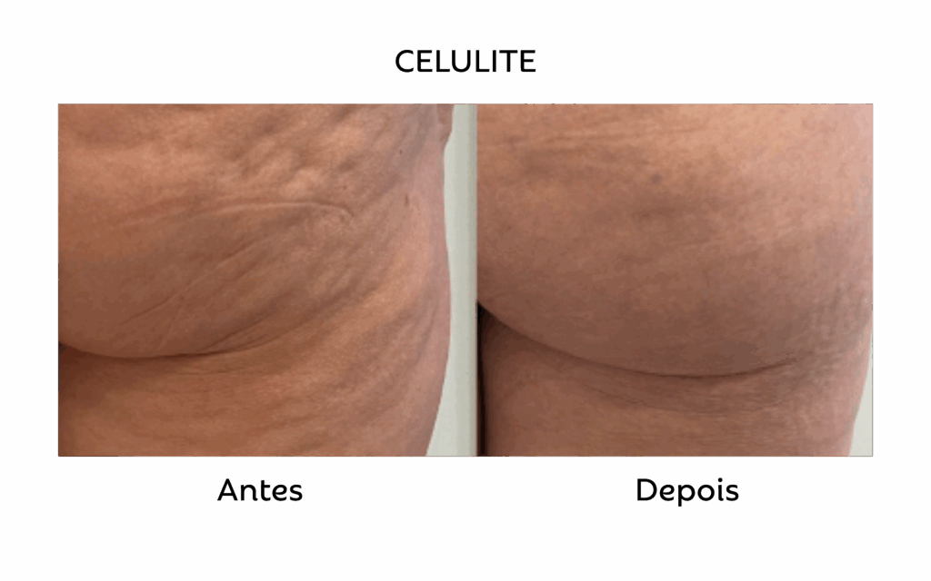 Comparativo de antes e depois identificado como celulite