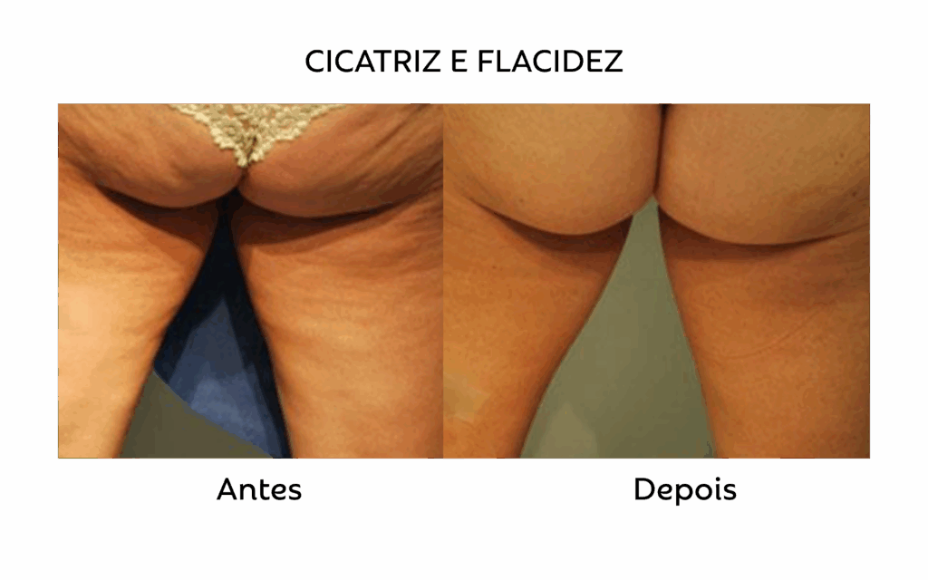 Comparativo de antes e depois identificado como cicatriz e flacidez